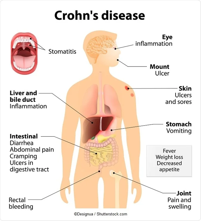 Crohn's diseases