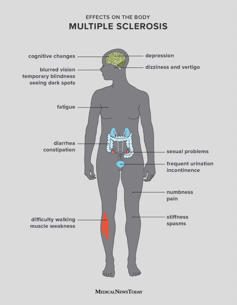 symptoms-of-Multiple sclerosis