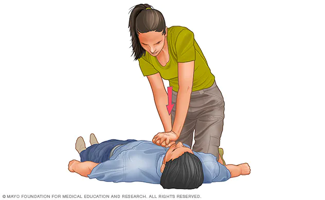 cpr-chest-compressions